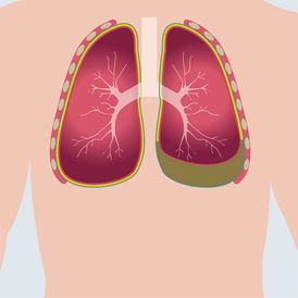 Pleural effusion and ascites