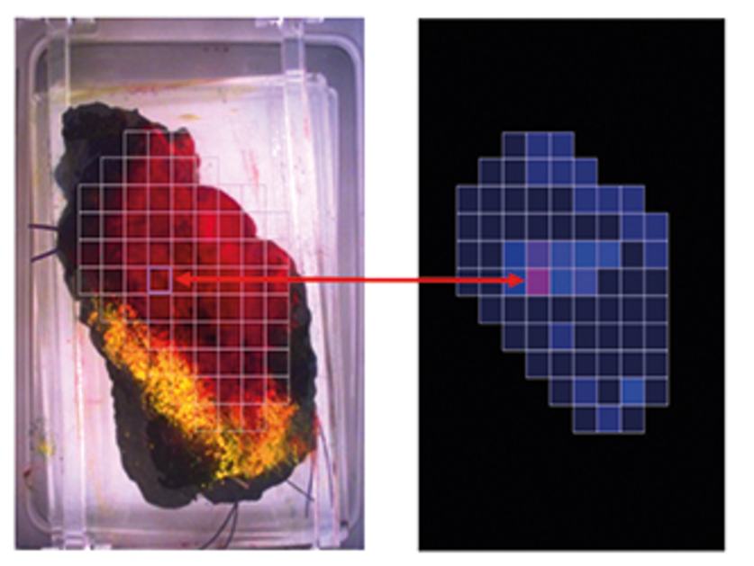 Photographic image of the excised inked tumor (left) Translation of ClearCoast™ output image; reddish pixels= high probability of malignant tissue (right)