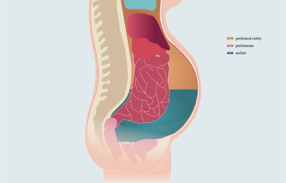 Schematic illustration of abdomen with ascites
