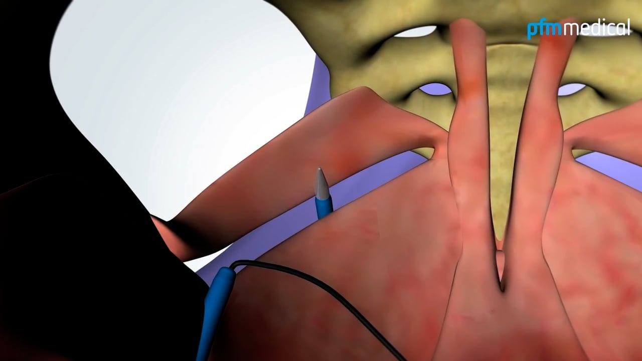 Animation: TiLOOP® PLUS-System (EN)
