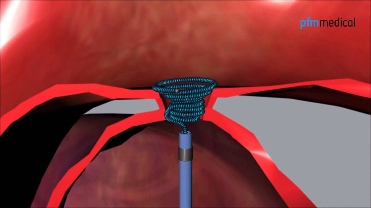 PDA Occlusion System: Nit-Occlud® PDA