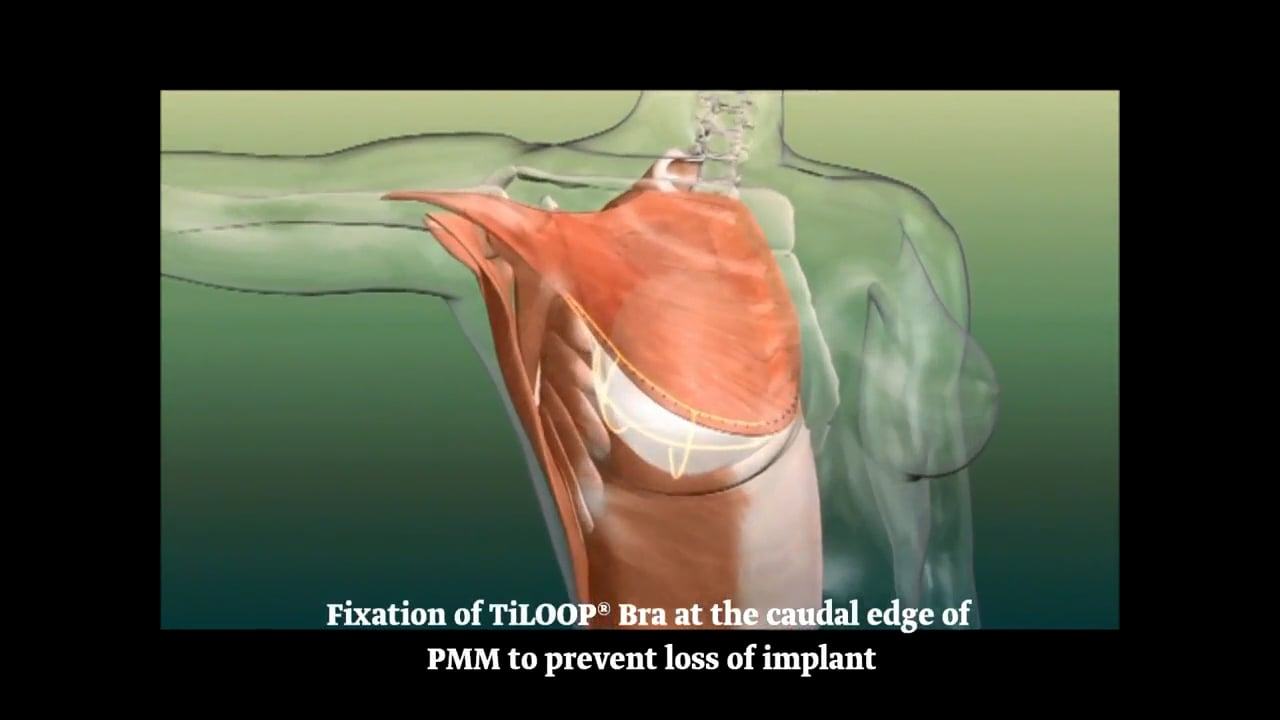 Animation TiLOOP® Bra