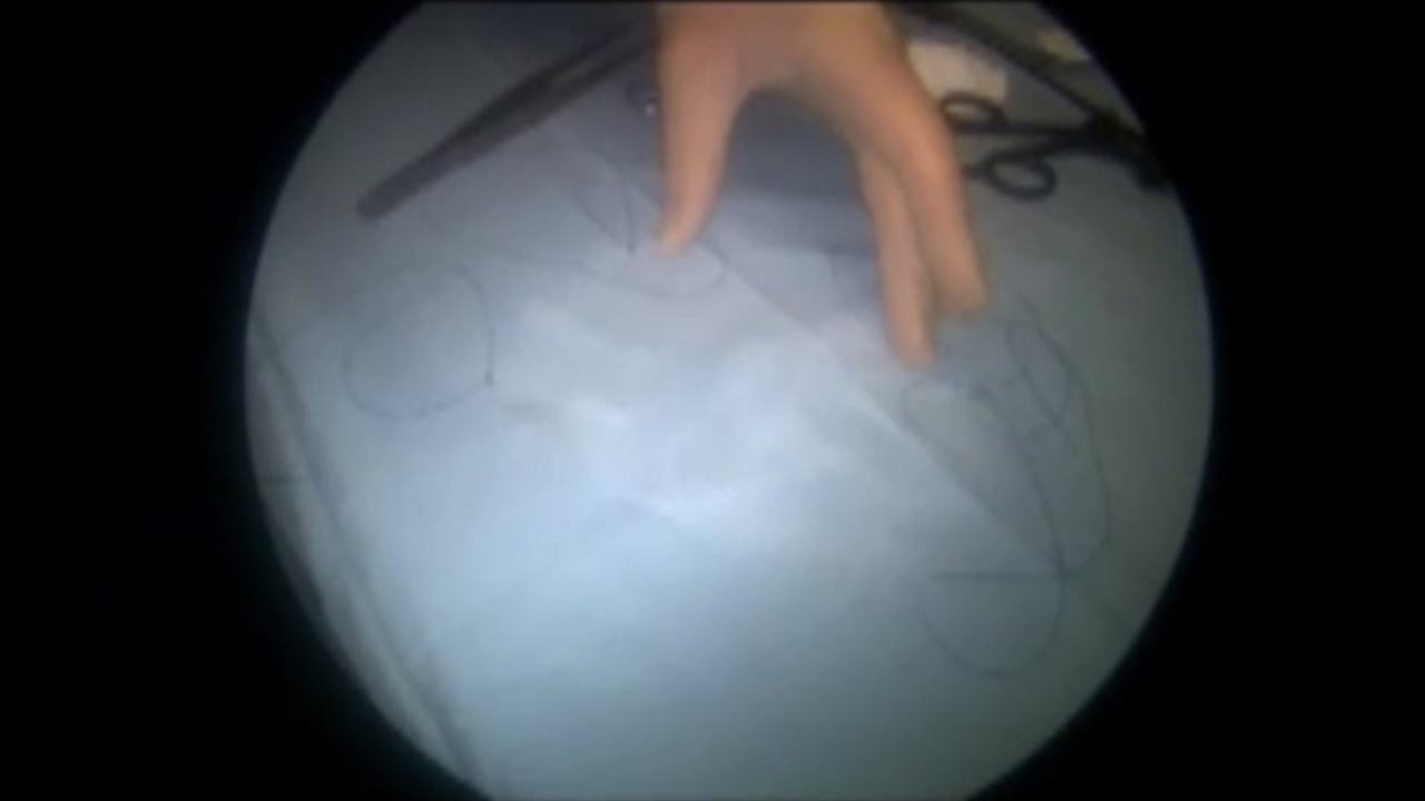 Incisional Hernia - IPOM Technique with TiMESH light